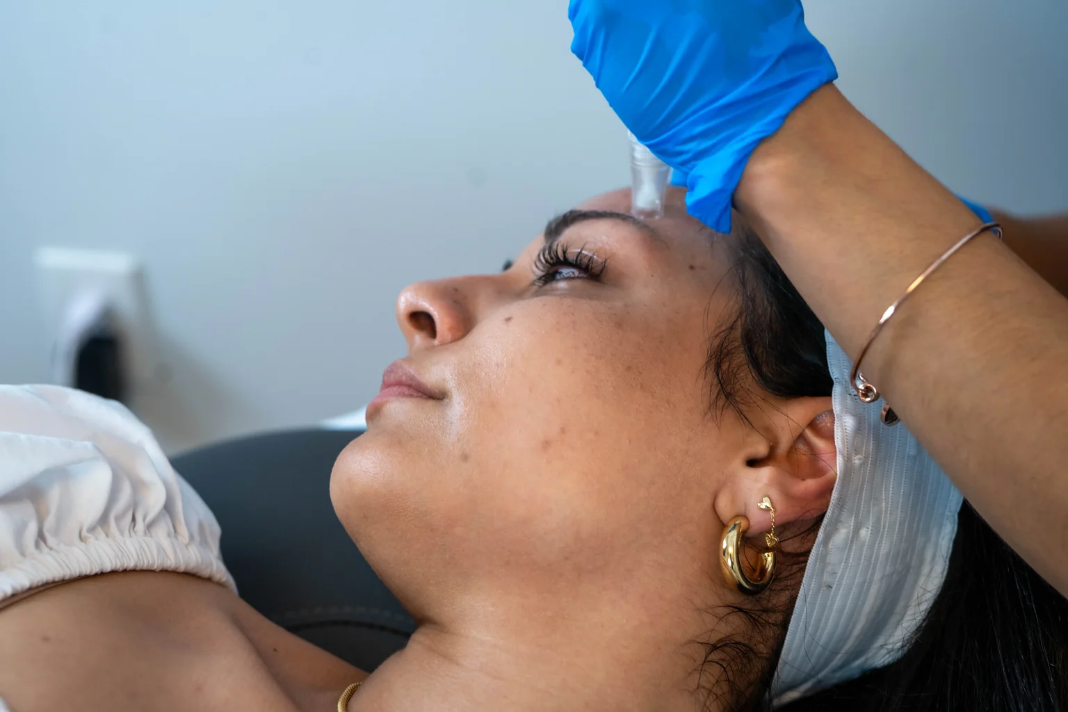 SkinPen microneedling treatment at AgeRejuvenation